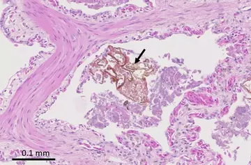 histology of a faveolus containing a fragment of foreign material