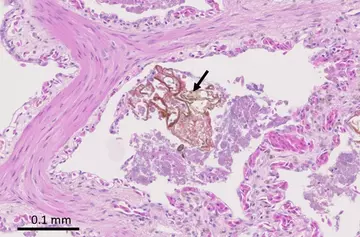 histology of a faveolus containing a fragment of foreign material